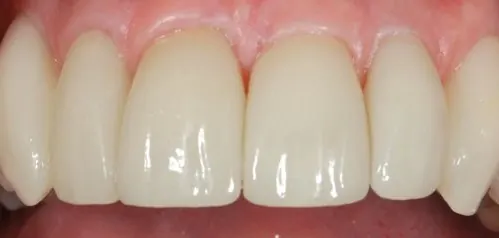 After: the same front teeth with new porcelain veneers.