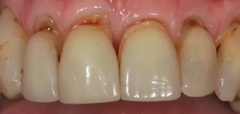 Before: front teeth with older bonding and veneers, stained at the gumline.