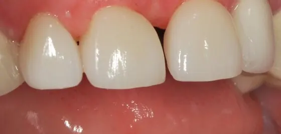 After: the front teeth restored with veneers, the gap kept.
