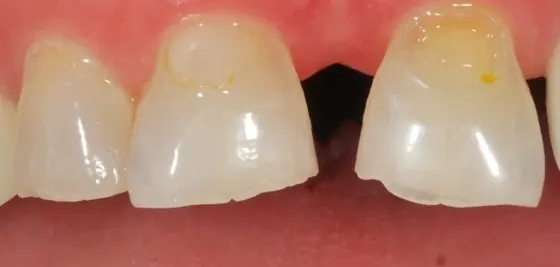Before: worn, chipped upper front teeth with a gap between them.