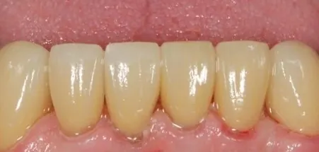 After: the lower front teeth restored to full length with crowns.
