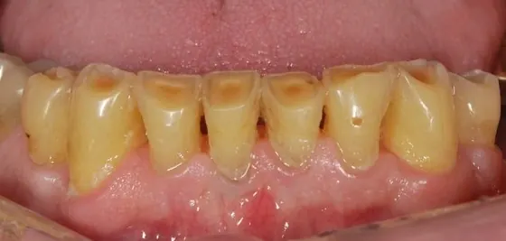 Before: lower front teeth worn short and stained.