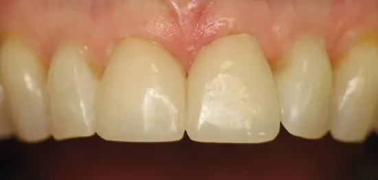 After: the two front teeth with new porcelain restorations.
