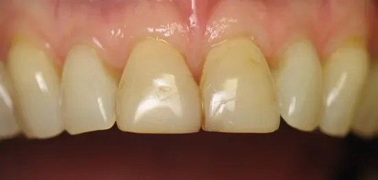 Before: two upper front teeth with worn, discoloured bonding.