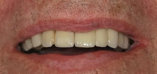 After: a full row of upper teeth, restored on implants.